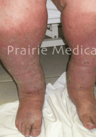 A person with psoriasis on their legs.