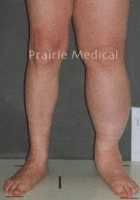 A man with a large leg vein on his lower legs.