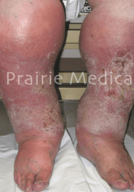 A person with psoriasis on their legs.